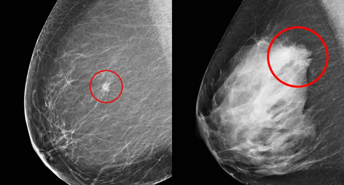 AI-Driven Automation in Mammography