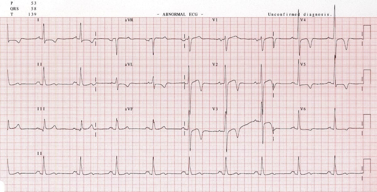 Critical Analysis of AI-enabled electrocardiography alerts