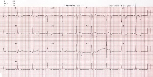 Critical Analysis of AI-enabled electrocardiography alerts